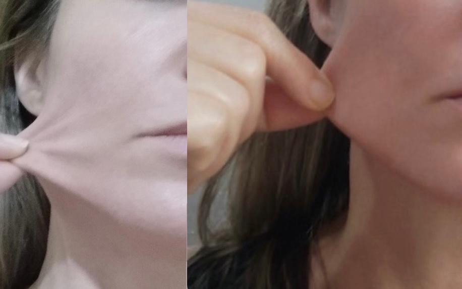 Bioestimuladores de Colágeno