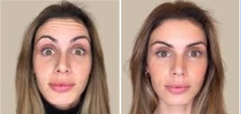 Botox Full Face