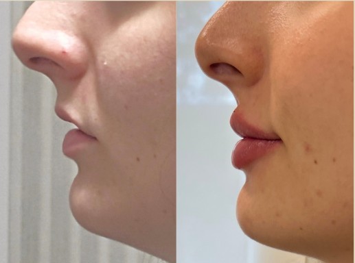 Harmonização Facial