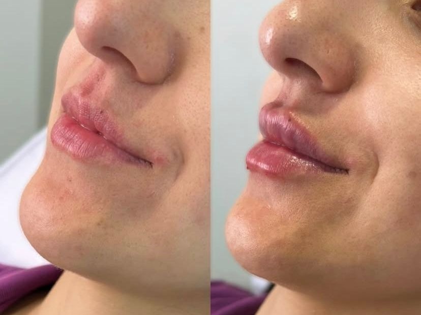 Preenchimento Labial