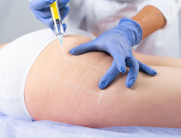 Mesoterapia