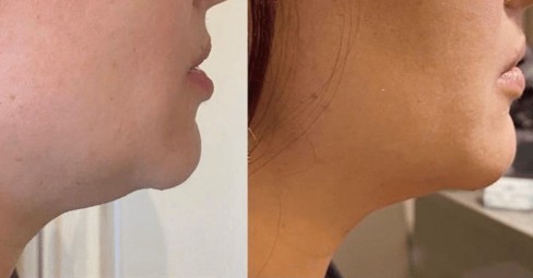 Lipo Enzimática de Papada
