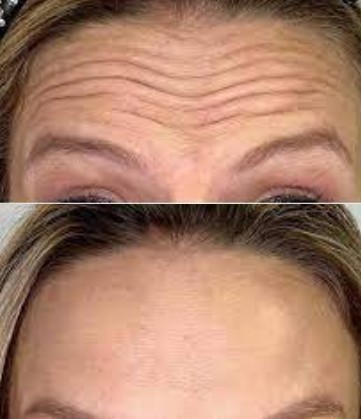 Botox Preventivo – Terço Superior
